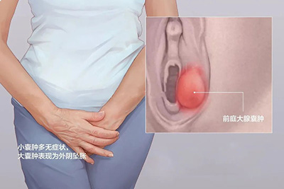 96382458.jpg 前列腺囊腫.jpg