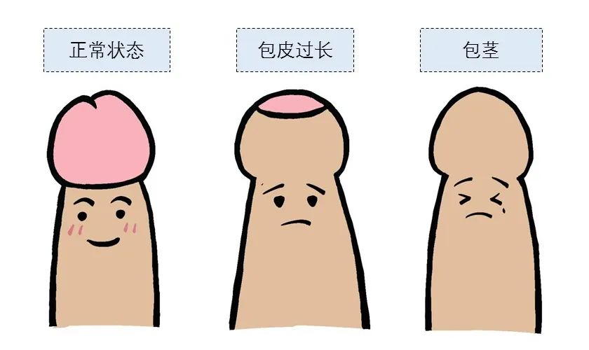 61061677.jpg 包皮過長包莖.jpg